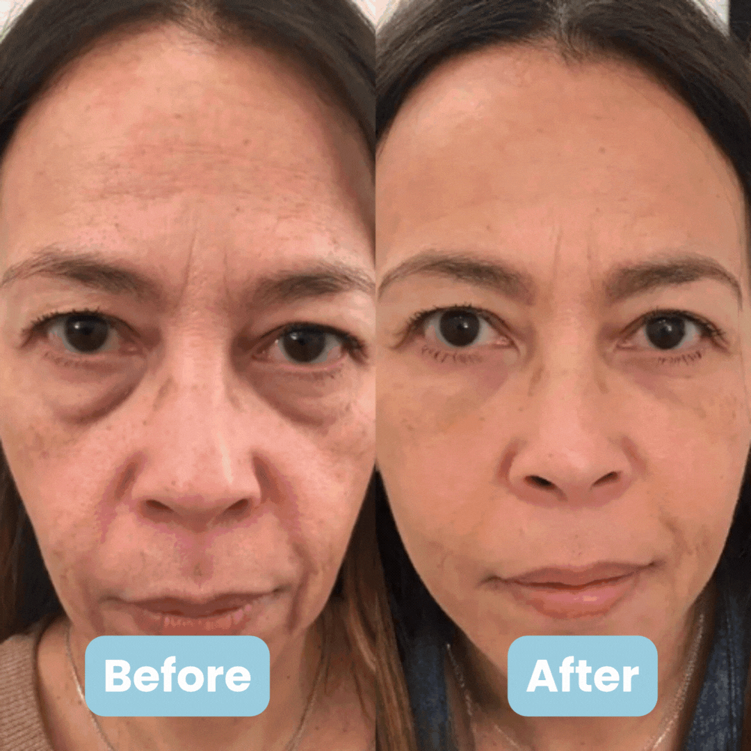 Auréa Skin I Sculpting System