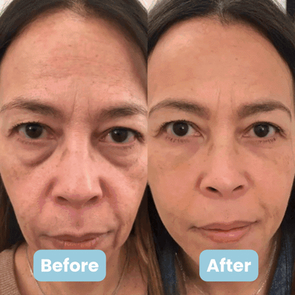 Auréa Skin I Sculpting System